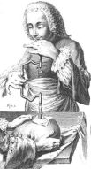 Trepanation_illustration_France_1800s